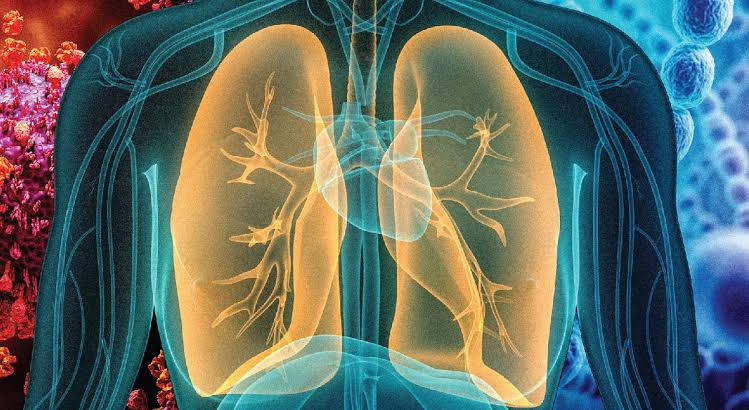 Rising Cases of Pneumonia Spark Health Advisory
